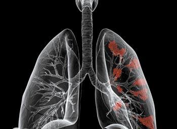 什么是肺癌？肺癌是如何产生的？