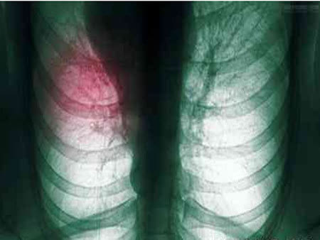 肺癌的早期症状，常见的有那些呢？ 康复乐园