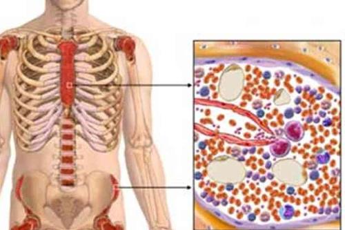 多发性骨髓瘤:越来越多见,认识需提高