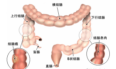 结直肠癌，进展期也别轻言放弃