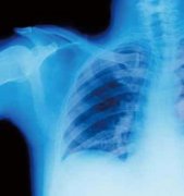 肺癌患者：选择活得长还是活得好