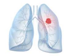肺癌诊疗进入精准医学新时代