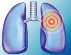  “肺癌规范化诊疗万里行”,肺癌诊疗进入精准医学新时代