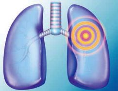 肺癌诊疗进入精准医学新时代