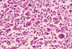 肺癌诊疗进入精准医学新时代