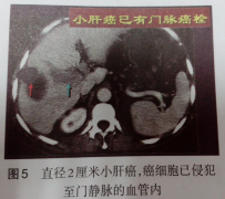 癌转移是晚期现象吗