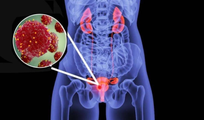 膀胱癌症状：血尿不是唯一信号，还有这些早期症状要当心！